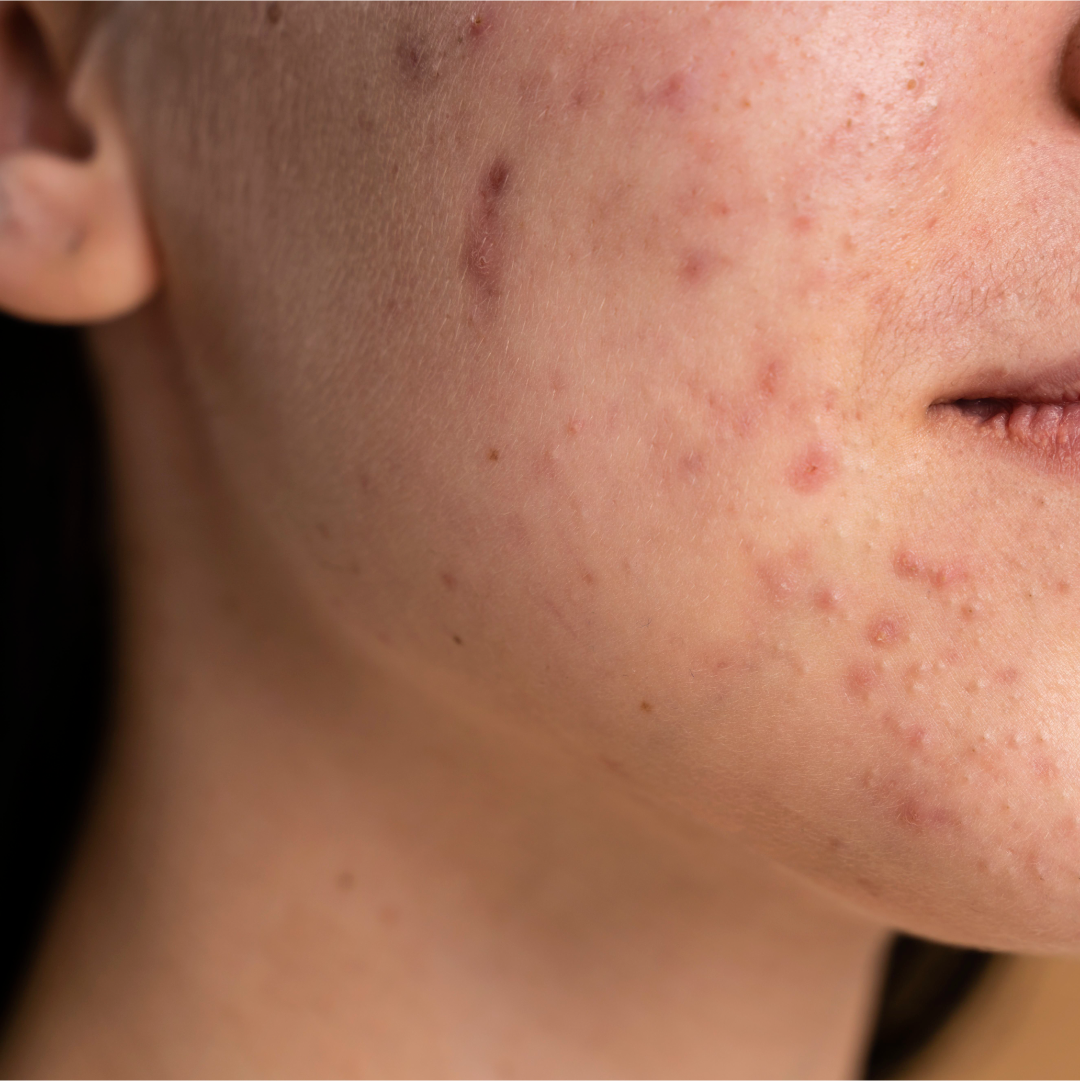 Best Tips On How To Treat A Scar On Your Face