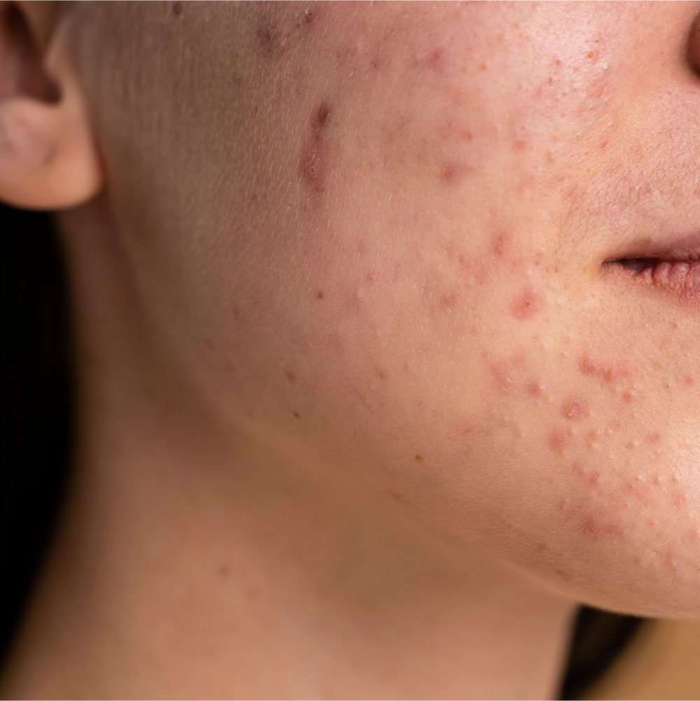 Best Tips on How to Treat a Scar on Your Face YourHappy Life