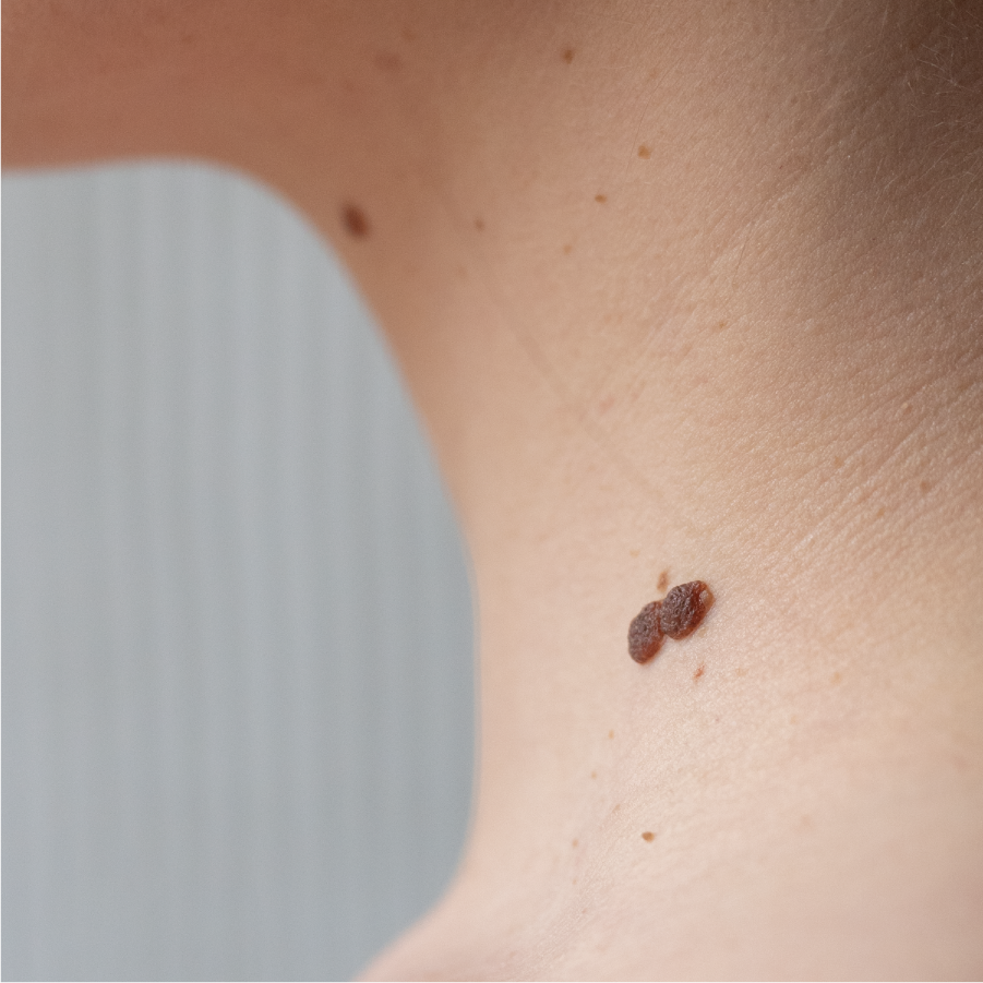 What Causes Skin Tags And How Do I Remove Them?