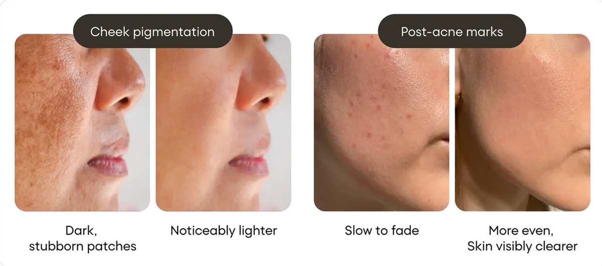 Spots faded faster than expected.